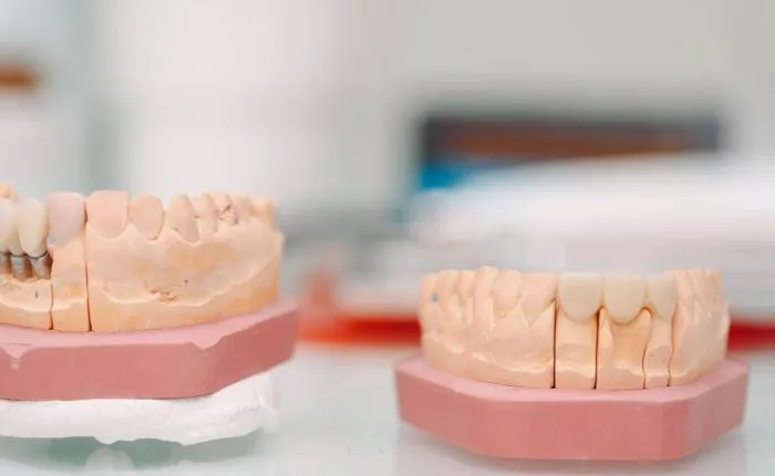 Crowns: Types, Who Needs Them, Benefits, Cost, Procedure, etc.