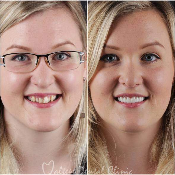 teeth_tranformation_case_6